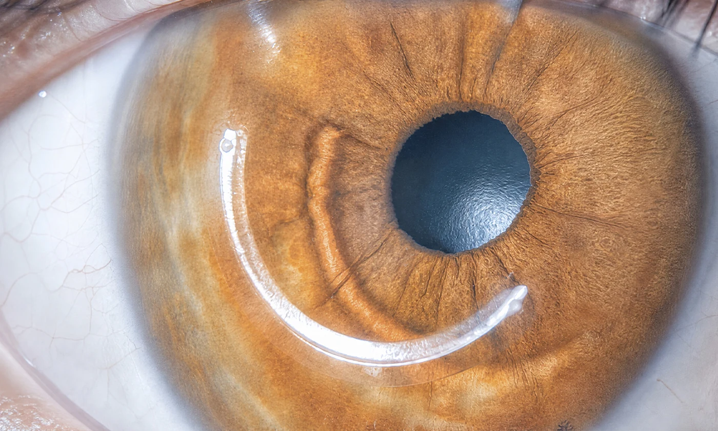 Anillos Intracorneales (ICRS)