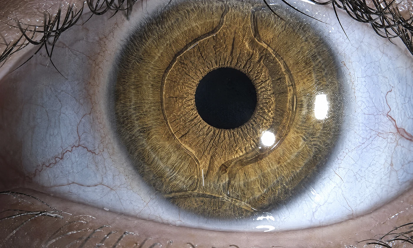Lente Intraocular Fáquico (ICL)